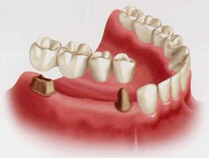 ballarat-dentist-fixed-bridges